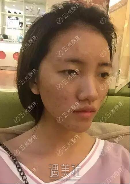 胶原蛋白隆鼻术果到底好不好|胶原蛋白隆鼻术案例力证~