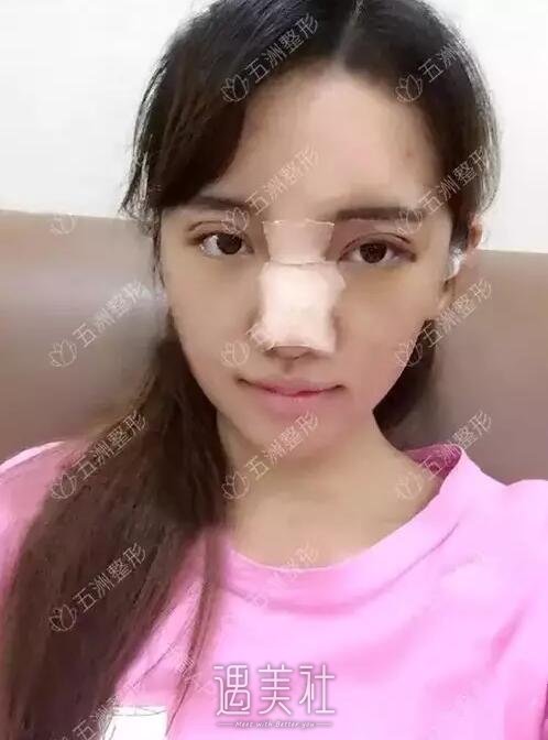 胶原蛋白隆鼻术果到底好不好|胶原蛋白隆鼻术案例力证~