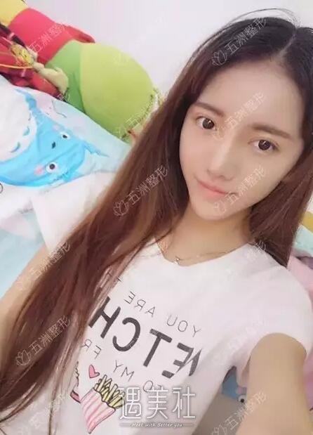 胶原蛋白隆鼻术果到底好不好|胶原蛋白隆鼻术案例力证~