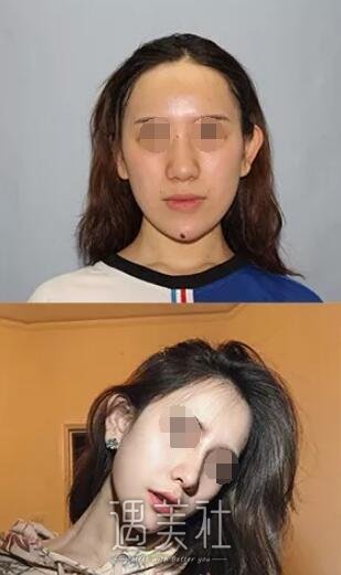 找广州曙光王旭明医生做了隆鼻，整张脸都变立体了呢!