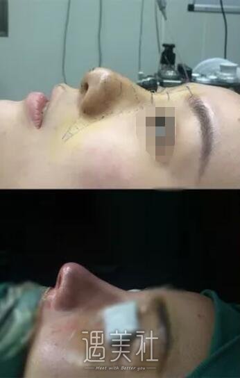 找广州曙光王旭明医生做了隆鼻，整张脸都变立体了呢!