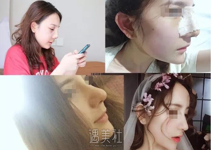 找广州曙光王旭明医生做了隆鼻，整张脸都变立体了呢!