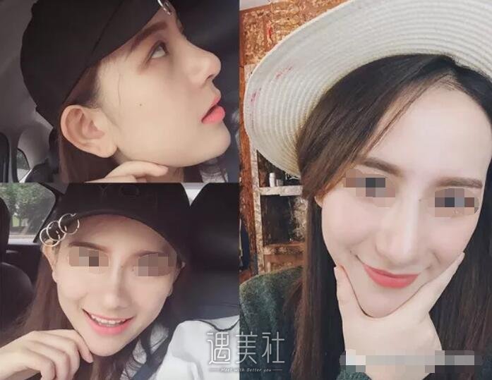 找广州曙光王旭明医生做了隆鼻，整张脸都变立体了呢!