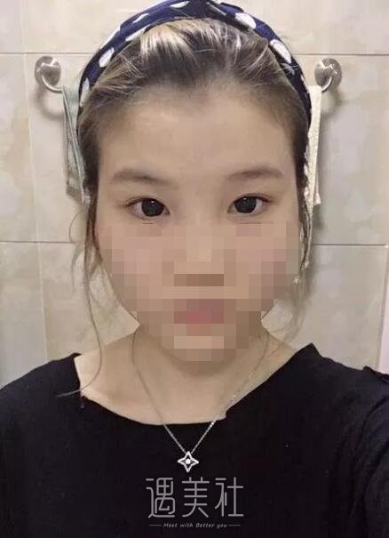侯亚杰做双眼皮怎么样?有他近期的双眼皮案例看看吗?
