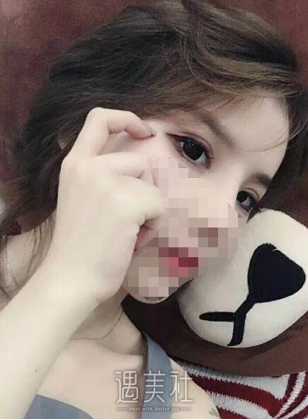 侯亚杰做双眼皮怎么样?有他近期的双眼皮案例看看吗?