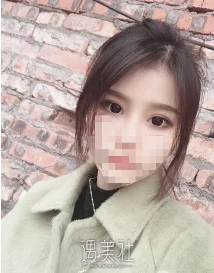 侯亚杰做双眼皮怎么样?有他近期的双眼皮案例看看吗?