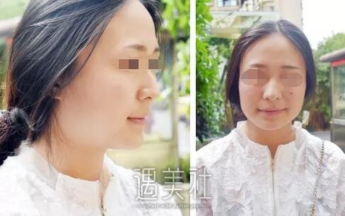 首尔丽格洪性范长曲线下颌角整形案例：恋上现在的我!