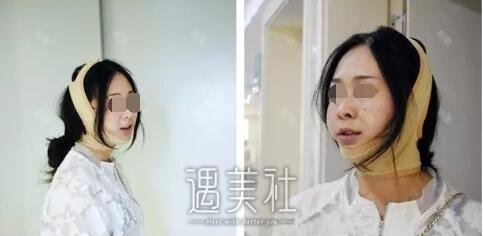 首尔丽格洪性范长曲线下颌角整形案例：恋上现在的我!