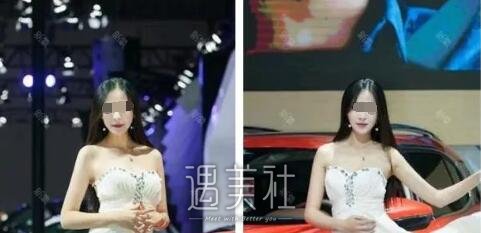 首尔丽格洪性范长曲线下颌角整形案例：恋上现在的我!
