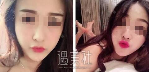 首尔丽格洪性范长曲线下颌角整形案例：恋上现在的我!
