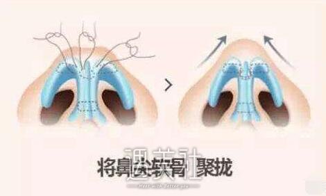 南宁鼻翼改薄整形要多少钱?跟着小编一起来了解下哇!