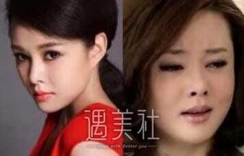 刘一含整容前后照片大肆流出，吃瓜群众表示这个八卦好～