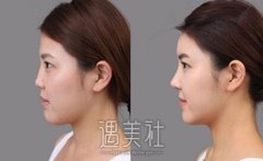 韩式注射隆鼻果能维持多久?该术式需要多次注射吗? width=