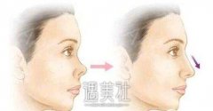 东莞做蒜头鼻整形术多少钱?我这蒜头鼻看着都烦呐! width=