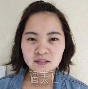 深圳福华整形医院好吗?看了这篇双眼皮案例就知道了! width=