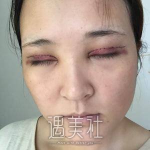切双眼皮