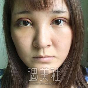 切双眼皮