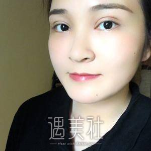 切双眼皮