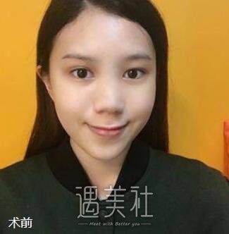 蒜头鼻