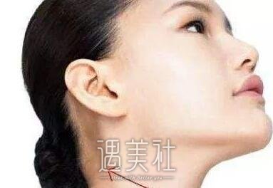 双下巴手术