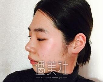 广州,曙光,万友望,脂肪填充