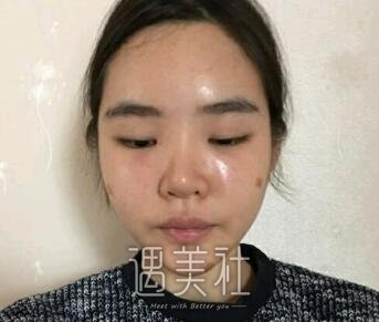广州,曙光,万友望,脂肪填充