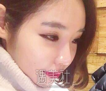 广州,曙光,万友望,脂肪填充