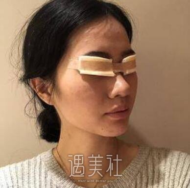 朴相根,韩式大眼