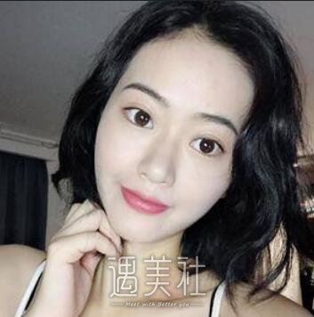 朴相根,韩式大眼