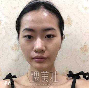 朴相根,韩式大眼