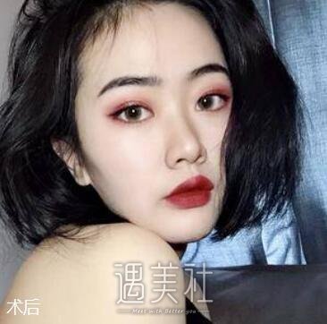 朴相根,韩式大眼