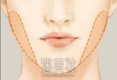 去颊脂垫术后有哪些注意事项？去颊脂垫术如何护理好？ width=