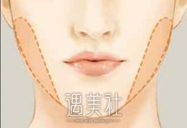去颊脂垫