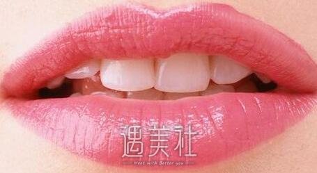 胶原蛋白丰唇