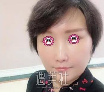 胶原蛋白丰唇