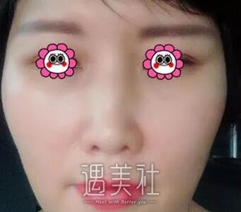 胶原蛋白丰唇