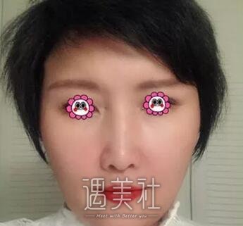 胶原蛋白丰唇