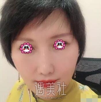 胶原蛋白丰唇