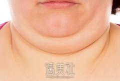 成都双下巴手术大概多少钱？拍照时双下班真是丑死了！ width=