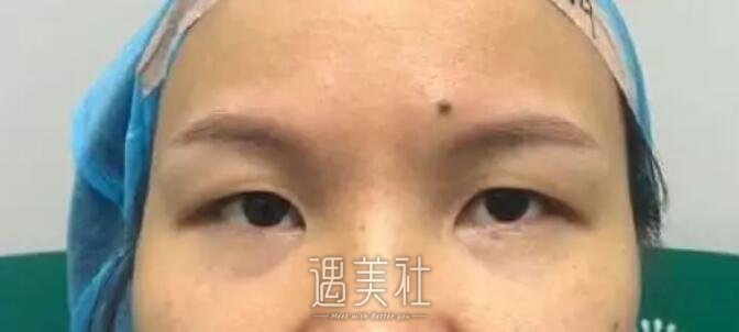 仁济医院黄一雄双眼皮案例