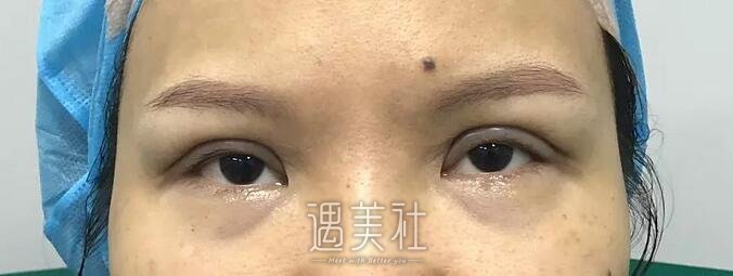 仁济医院黄一雄双眼皮案例