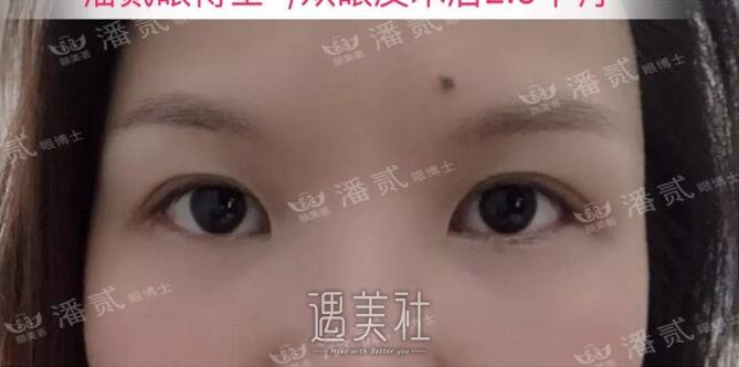 仁济医院黄一雄双眼皮案例