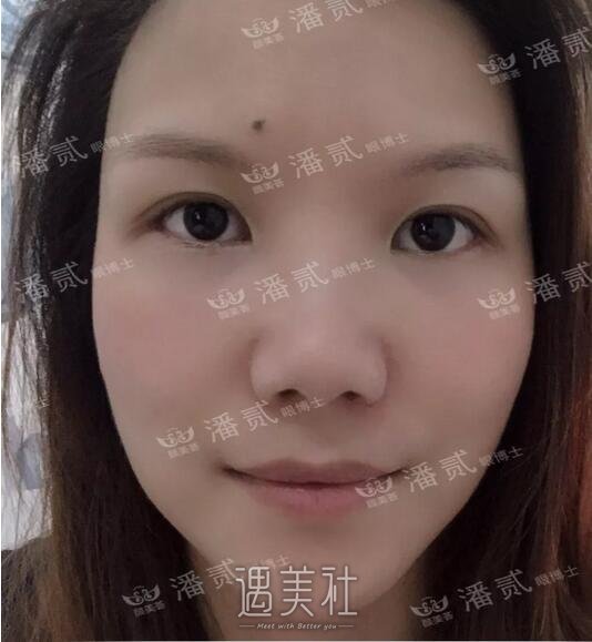 仁济医院黄一雄双眼皮案例