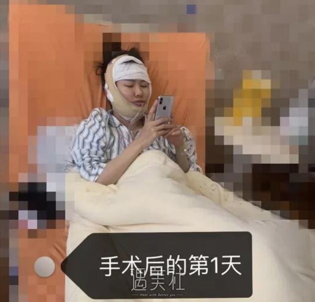 柴岗下颌角磨骨案例展示