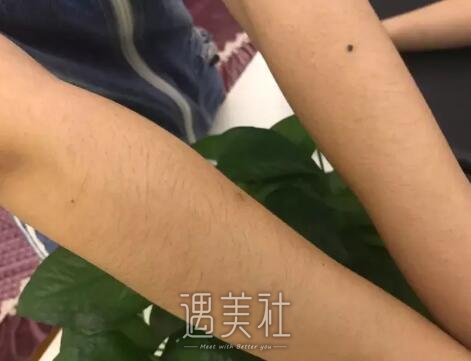 陈锦安激光脱毛案例展示