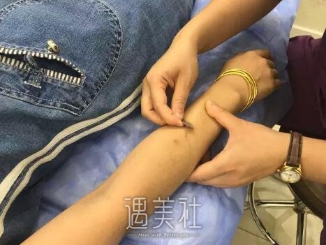 陈锦安激光脱毛案例展示
