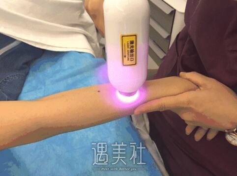 陈锦安激光脱毛案例展示