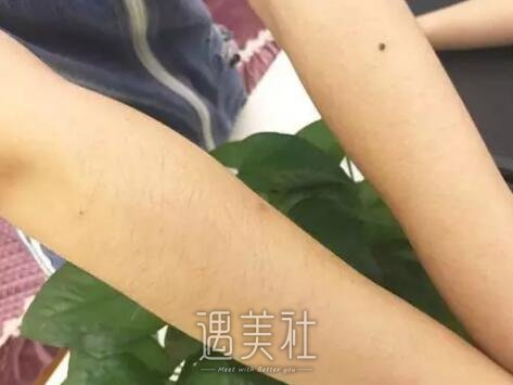 陈锦安激光脱毛案例展示
