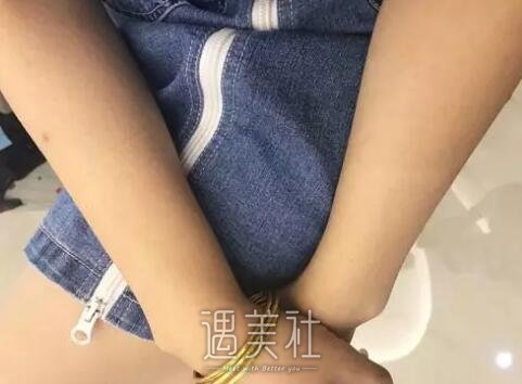 陈锦安激光脱毛案例展示