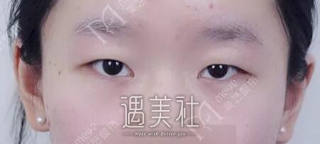 陈锦安双眼皮案例分享|眯眯眼就此离我而去!
